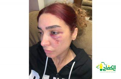 “روجينا” تتصدر تويتر بعد نشر صورة لإصابتها أثناء التصوير