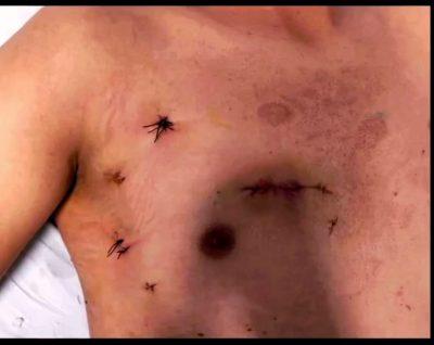 مستشفى كفر الشيخ الجامعي بجمهورية مصر العربية يُجري أول عملية لتغيير الصمام المترالي بالمنظار، وإنجاز طبي رائد يضع الجامعة في صدارة المؤسسات الطبية المصرية