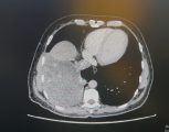 مجمع الملك عبدالله الطبي بجدة ينجح في استئصال ورم نادر وعالي الخطورة أسفل القلب بالمنظار