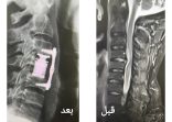 إنقاذ مريض من شلل الأطراف العلوية